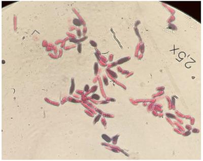 Case Report: Trichosporon japonicum Fungemia in a Pediatric Patient With Refractory Acute B Cell Lymphoblastic Leukemia